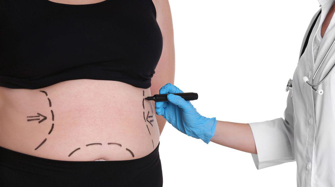 Obezitatea De Ce Sunt Mai Multe Femei Care Apelează La Chirurgie Bariatrică Decat Bărbați