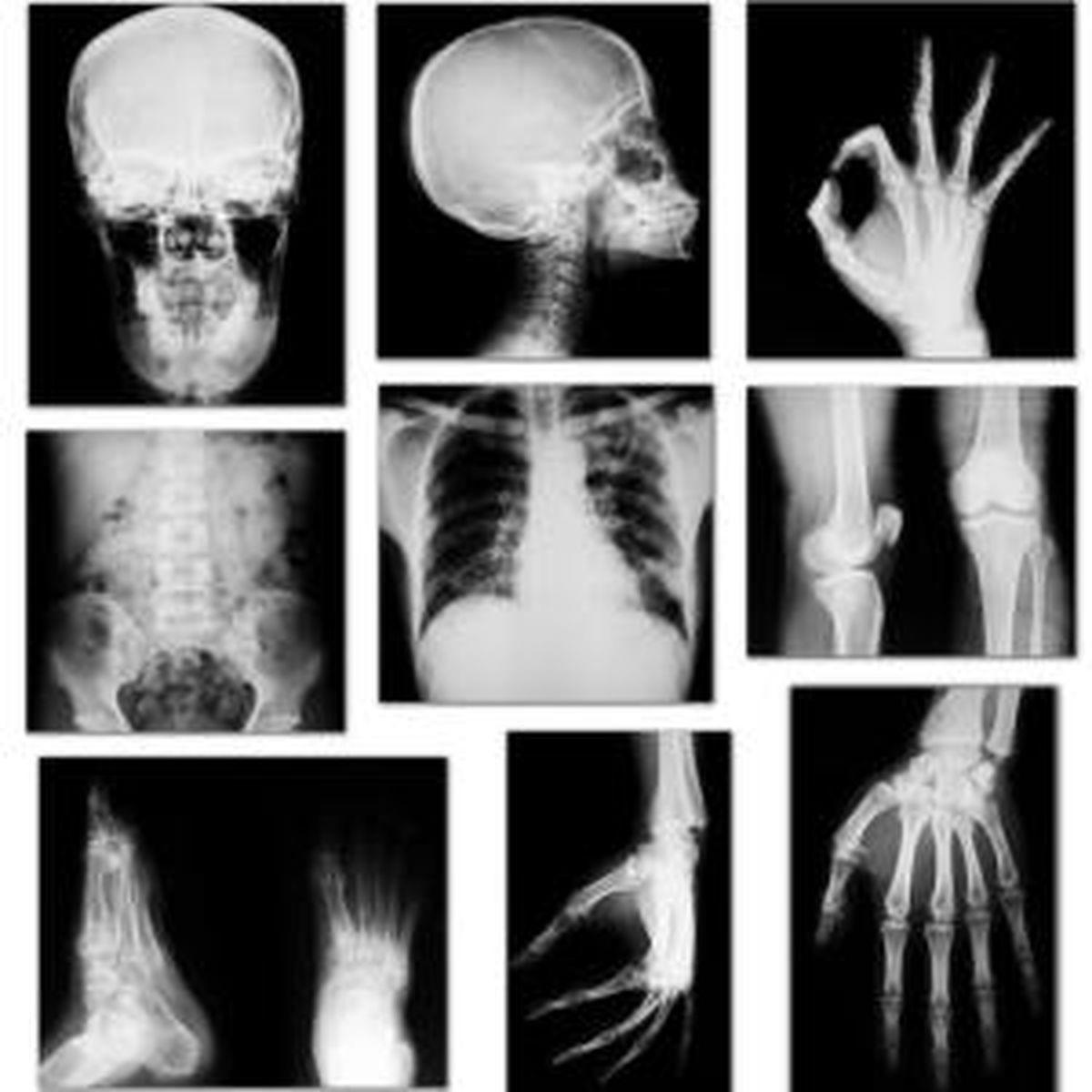 Cum Funcţionează Razele X Si De Ce Sunt Utile Sănătate Unica Ro
