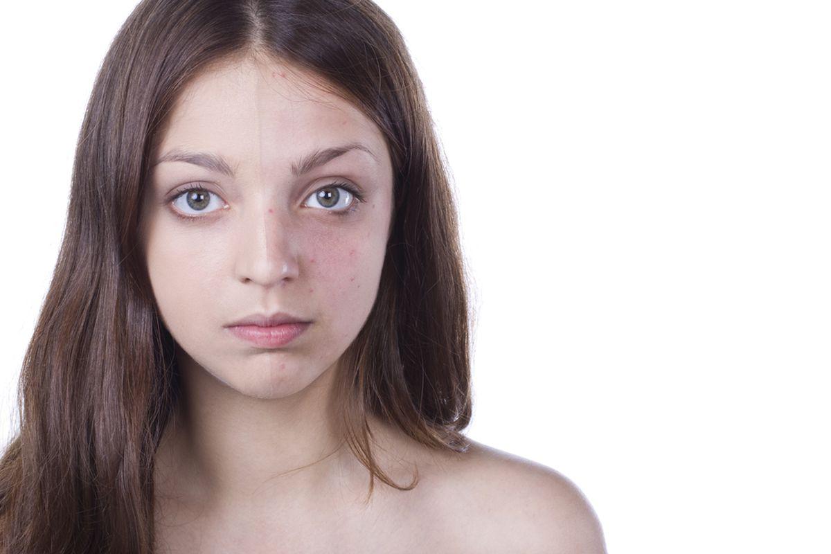 Dermatita Simptome Cum Stii Ca Ai Un Anumit Tip De Dermatita