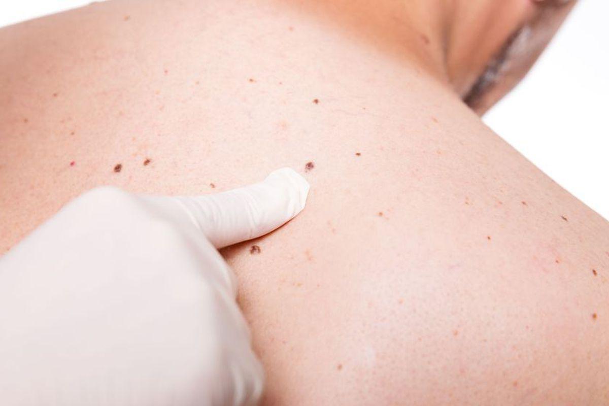 Cancerul De Piele Ce Este Cum Poți Preveni Apariția Lui și Cum Il Poți Trata