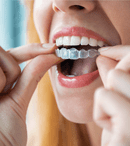 Fațete dentare sau aparat dentar: Alegerea corectă pentru o dantură perfectă