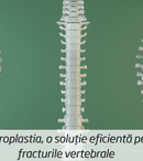 Vertebroplastia, o soluție eficientă pentru fracturile vertebrale