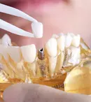 (P) Cum se inseră implantul dentar