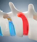 Cum să ameliorezi simptomele herniei de disc fără intervenție chirurgicală!