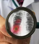 6 cauze comune ale pneumoniei