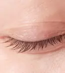 12 cele mai frecvente afecțiuni ale pleoapei