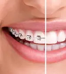 (P) Alege acum un tratament cu aparat dentar si scapa de griji zambind!