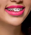 Factori care influențează costul unui aparat dentar