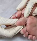 De ce persoanele cu diabet ar trebui să consulte un podolog o dată la 3 luni