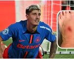 David Miculescu, out în derby-ul cu U Craiova? Cum arată piciorul căpitanului FCSB după accidentarea din meciul cu Petrolul