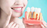 (P) Implantul dentar – soluția perfectă pentru recâștigarea zâmbetului