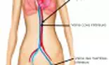 Ateroscleroza – ucigaşul care ne pândeşte