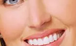 Fatetele dentare – perfectiunea zambetului