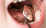 Cu copilul la medicul dentist. Sigilarea molarilor de 6 ani