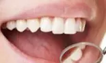 Avantajele şi dezavantajele implanturilor dentare