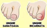 Cum să îngrijești unghiile incarnate