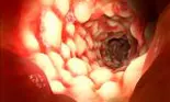 Cum se manifestă boala intestinală inflamatorie