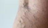 Ceapa roșie vindecă varicele! Cum se prepară remediul naturist care dă rezultate senzaționale