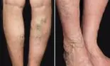 Cum să scapi de VARICE în două săptămâni? Leacul natural care face minuni