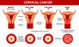 Cele mai bune tratamente pentru cancerul de col uterin! Sfaturile prețioase ale unui medic ginecolog