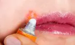 Cum să scapi de herpes în sezonul rece? Cele mai bune remedii naturale