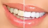 Se mai pot albi dintii dupa implantul dentar? Daca da, cum?