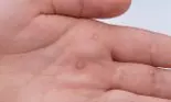 Cel mai bun remediu natural pentru vindecarea negilor! Este ieftin și eficient, iar rezultatele apar foarte repede