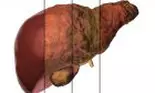 Ce este fibroza hepatică și care sunt cauzele care duc la apariția acestei boli?
