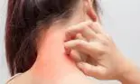 Alimentele pe care trebuie să le eviți dacă suferi de dermatită. Îți pot agrava starea de sănătate