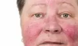 Cum să scapi de cuperoză și de roșeața inestetică a feței? Cele mai bune tratamente naturale pentru capilarele sparte și hiperpigmentarea tenului