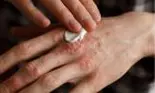 Alifia care îți vindecă rănile și arsurile rapid, fără să rămâi cu semne pe piele. Conține un antibiotic natural