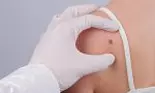 Cum arată MELANOMUL?