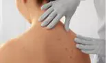 Cancer de piele. Cum arată și care sunt cele mai întâlnite tipuri?