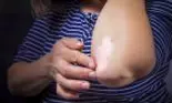 Psoriazisul nu este contagios! Peste 2% din populaţia României suferă de psoriazis