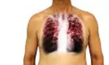 Descoperire senzațională a medicilor spanioli: în cât timp se instalează pneumonia după infectare