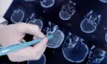 O femeie a trăit cu un vierme de 10 cm în creier