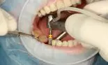 (P) Cele mai bune tipuri de implanturi dentare
