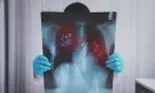 În atenția celor care au avut COVID: CT-ul pulmonar este esențial în evaluarea procesului de vindecare