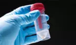 Noul test din salivă care poate prezice dacă veți face forme severe în urma infectării cu Covid-19