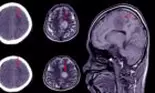 Cum se face recuperarea după un accident vascular cerebral? Abordare integrată, cu viziune regenerativă