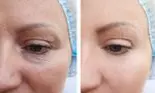 Dr. Dana Bratu:„Biorevitalizarea și rejuvenarea pielii fără ace poartă un singur nume, PRX-T33'