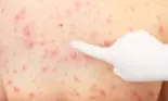 Diferența dintre variola maimuțelor și varicelă. Iată deosebirea dintre cele două boli