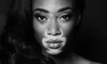 Cum arată acum Winnie Harlow, fotomodelul cu pielea în două culori. Care e boala de care suferă
