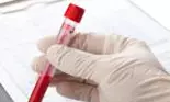 Românii beneficiază de analize gratuite pentru diagnosticarea Bolii Cronice de Rinichi, începând cu 1 iulie
