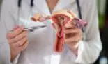 „Peste 90% dintre cancerele de col uterin sunt determinate de o infecție cu o tulpină HPV de risc înalt'