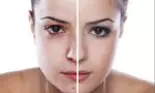 Cum știi dacă acneea ta are cauze hormonale? Medicul explică: „Această afecțiune se prezintă sub diverse forme'