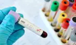 Un bărbat din Germania este a șaptea persoană vindecată complet de HIV