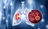 Prima persoană vaccinată împotriva cancerului pulmonar: un bărbat de 67 de ani din Marea Britanie