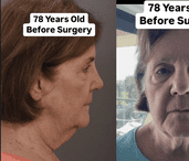 O femeie de 78 de ani și-a șocat până și soțul, după o operație estetică la față, care a întinerit-o brusc: "Asta e ce mi-am dorit"