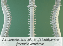 Vertebroplastia, o soluție eficientă pentru fracturile vertebrale